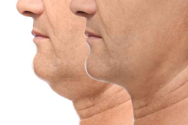 HIFU - Breakthrough in Anti - ageing 2 hifu results England