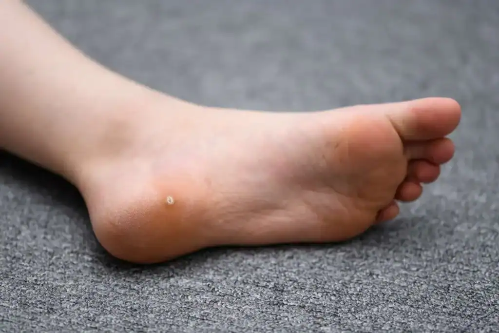 Cryotherapy For Warts And Also Verrucas 2 Image of verruca on the bottom of the foot that able to be treated with Cryotherapy England