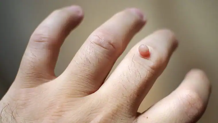 Cryotherapy For Warts And Also Verrucas 1 Image of blemish that Cryotherapy England can remove with Lipo 360.