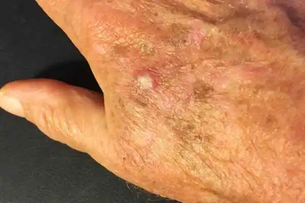 Image of Actinic keratoses England on a person hand