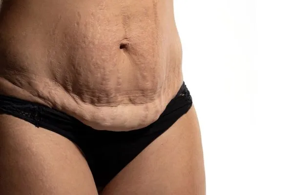 The science behind skin tightening England picture of a woman's sagging skin on the stomach
